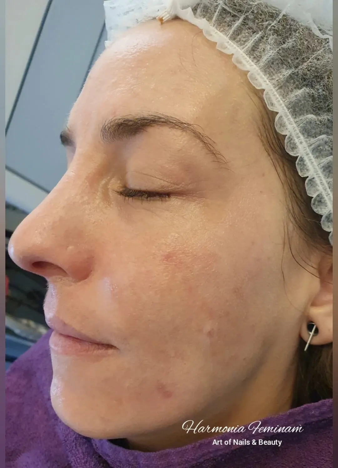 Ebenmässige Haut nach BB Glow