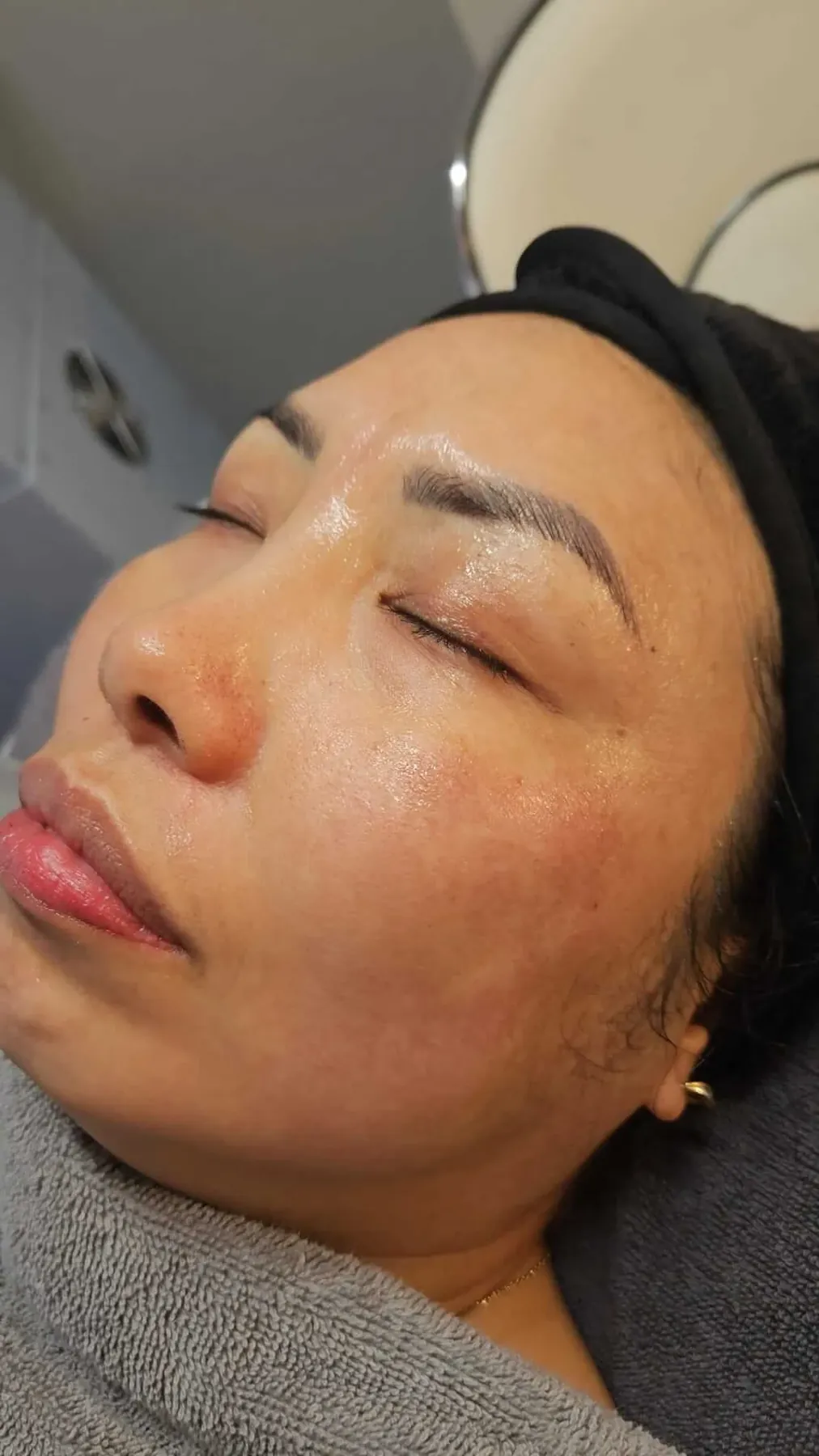 Strahlende Haut nach BIOPeelX