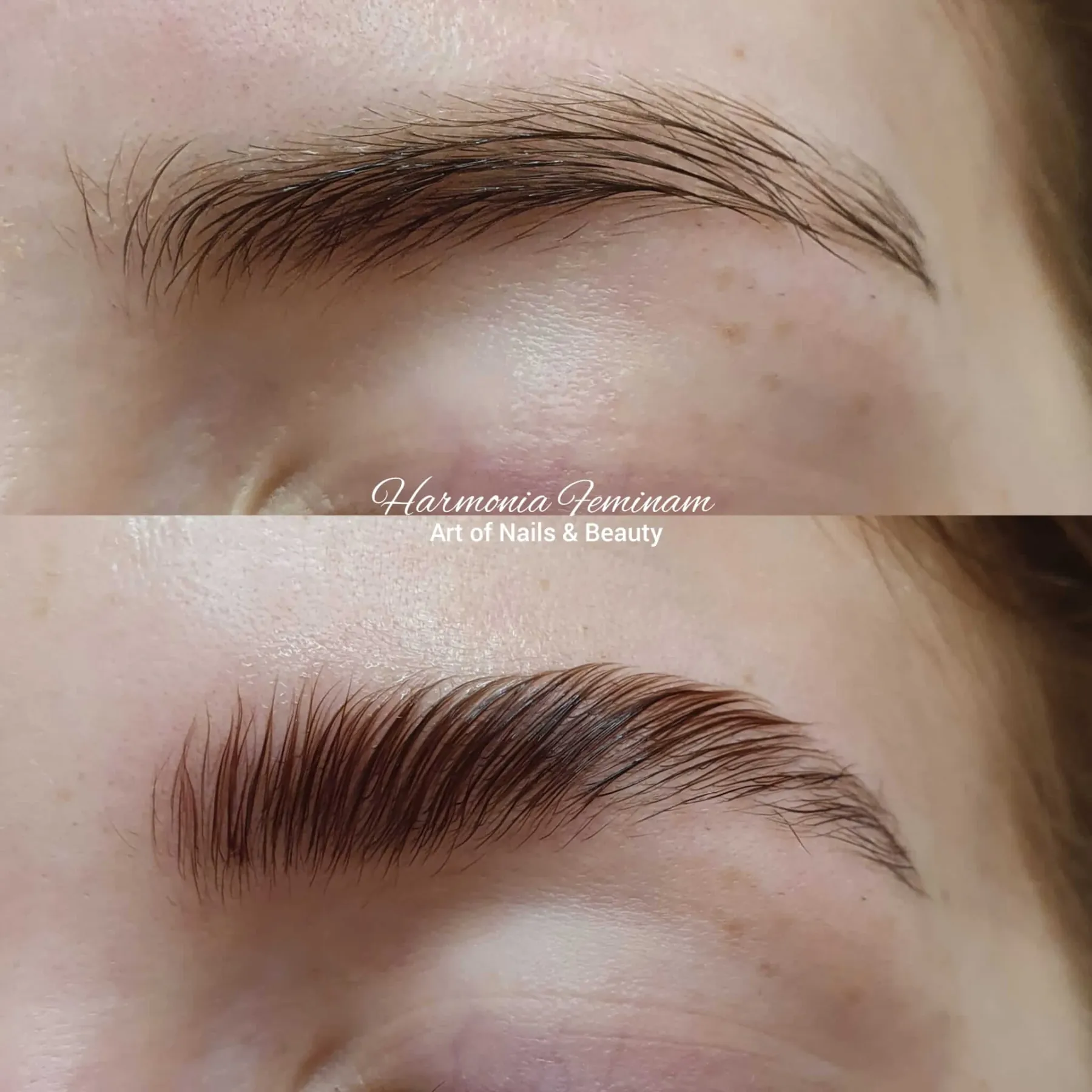 Brow Lifting vorher und nachher
